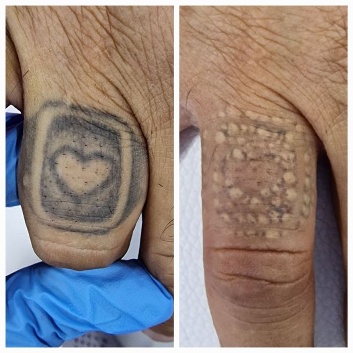 Удаление татуировок  и татуажа