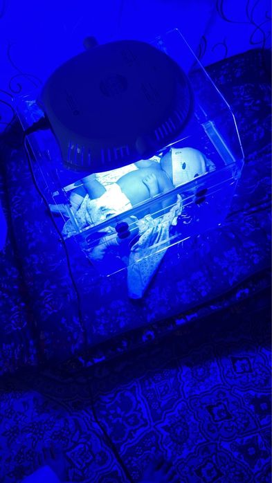 Фотолампа от желтушки