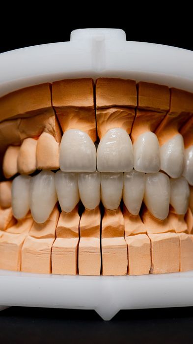 Диоксид-циркония  Керамика  коронки и протезирование