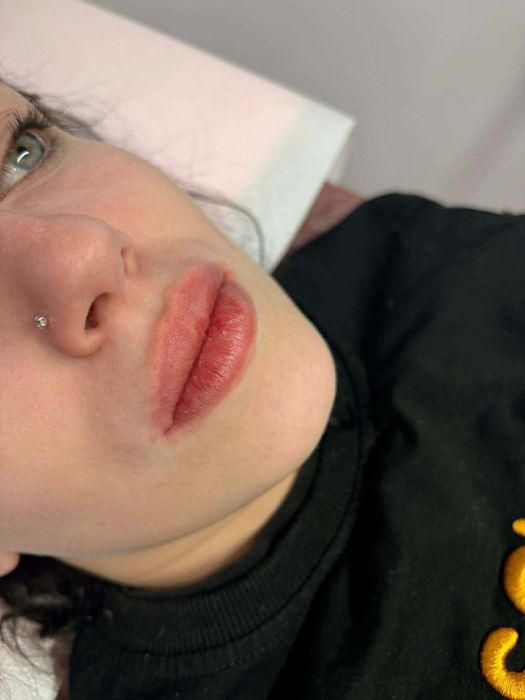 400 lei Buze hialuron pen 1 ml revolax