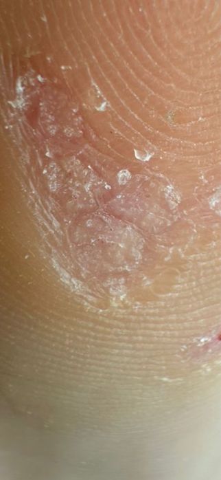 Медицинский педикюр от 10000