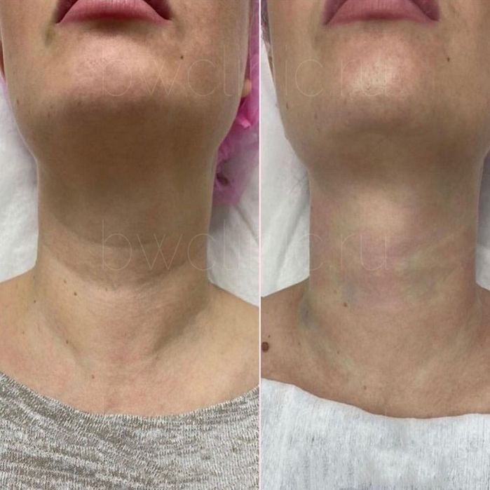 Акция Ботокс лица