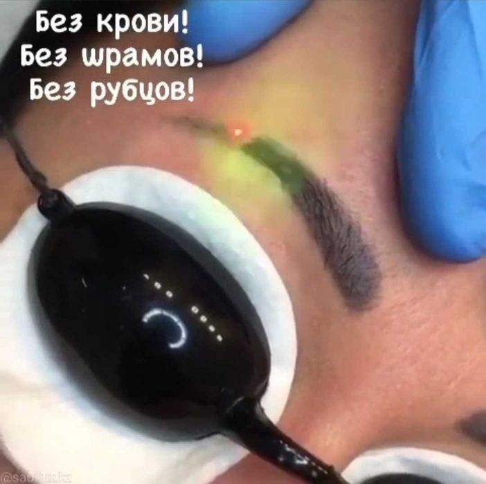 Удаление тату и  татуажа