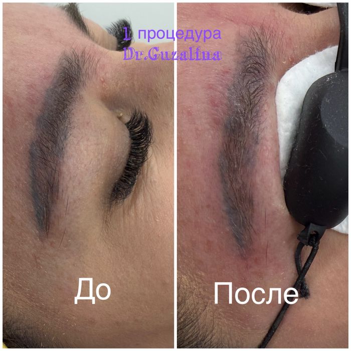 Удаление старого татуажа