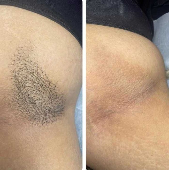 Депиляция для мужчин и женщин