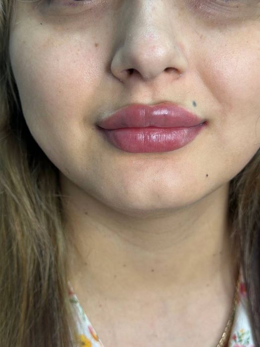 Красота это -губки бантиком на новый год! Botox full face