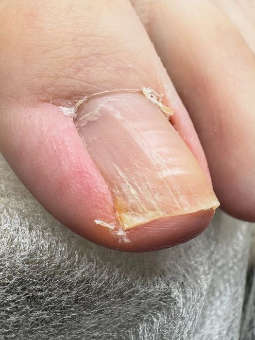 Ичига усган тирнок,Подолог хизмати