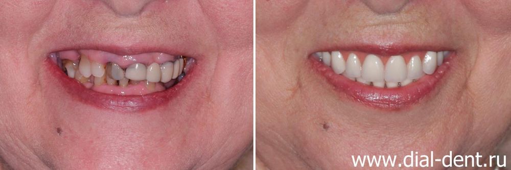 стоматология наращивание зубов