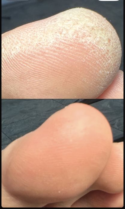 Педикюр, чистка стоп, ногтей