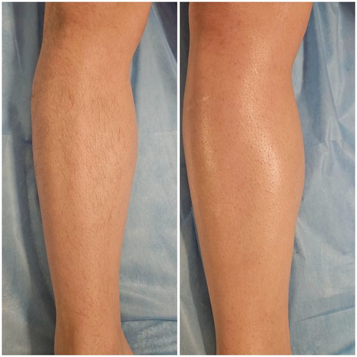 Epilare femei și bărbați, tratament cu parafina mâini și picioare