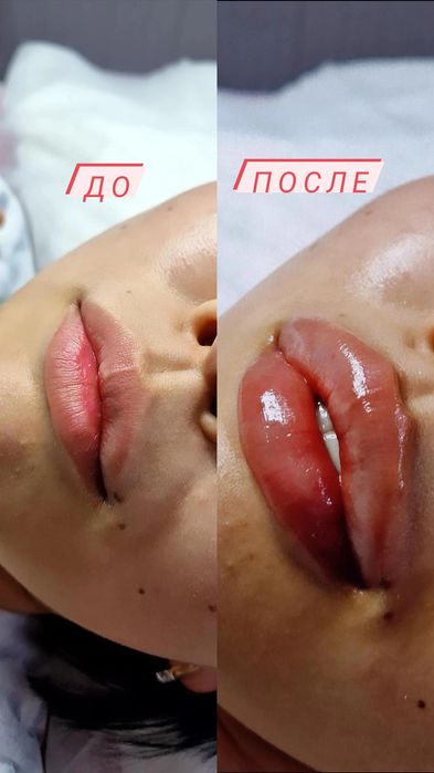 Увеличение губ Косметолог