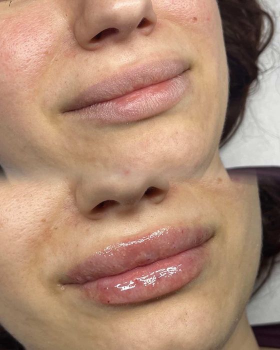 Volumizare buze -hyaluron pen