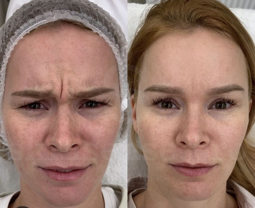 Ботокс 100% на 6-8 мес