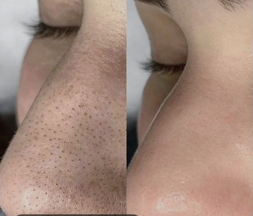 Акция по 250 тысяч Чистка лица ПилингКарбокситерапия механическая чист