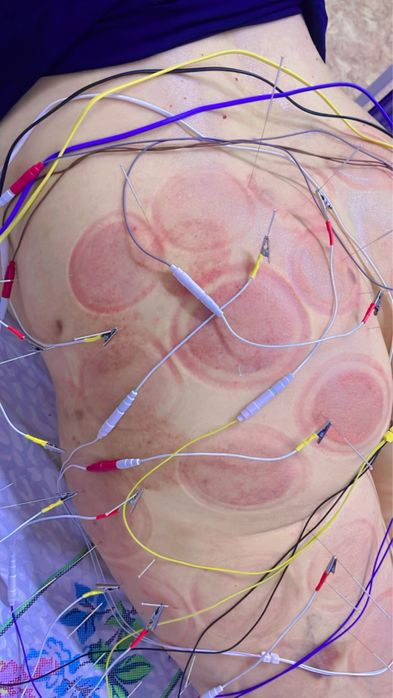 лечение Иглотерапией в Шымкентте