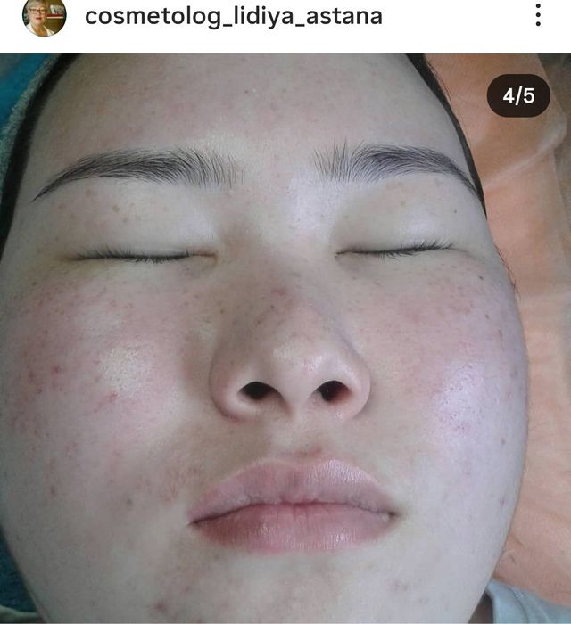 ЧИСТКА ЛИЦА от 7000.