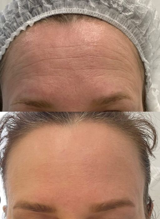 Ботокс. Лоб, межбровка,глаза.  Шея, овал лица