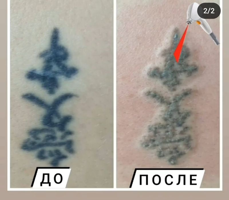 Продам лазер для удаления татуажа и татуировок