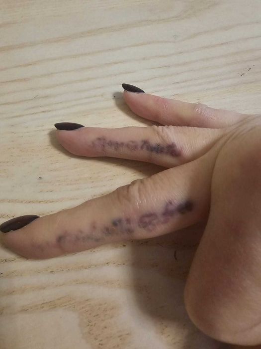 Stergere tatuaje la nivelul sprancenelor si corporale.