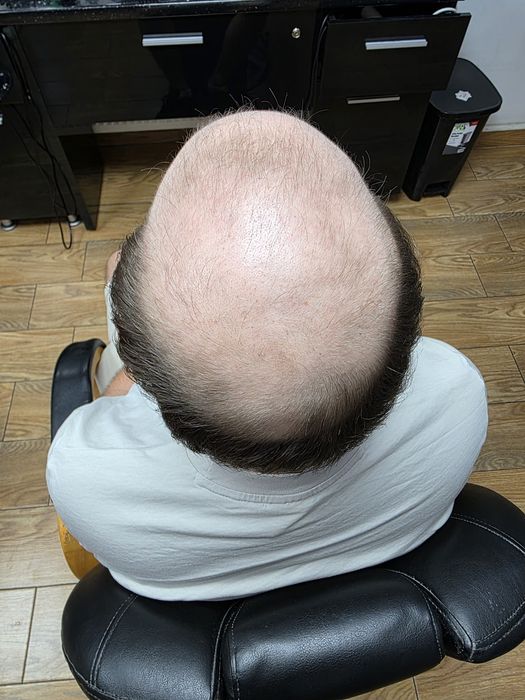 Top hair system barbati