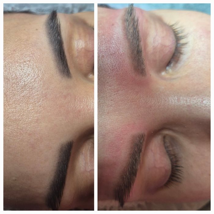 Удаление татуажа брови. 300 тысяч