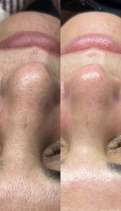 Чистка лица за 5.990