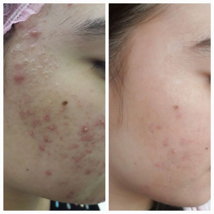 Врач косметолог. Ташкент. Атравматичная, комплексная чистка лица