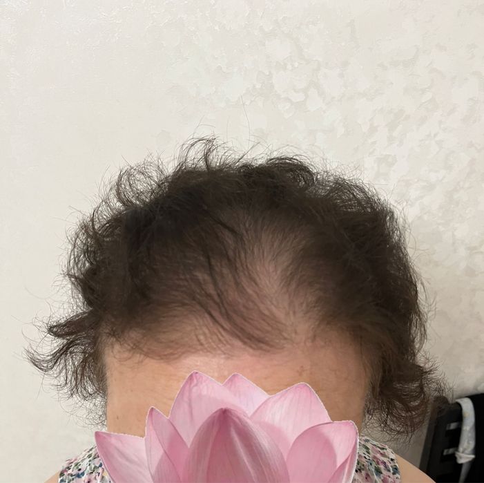 Теменная накладка