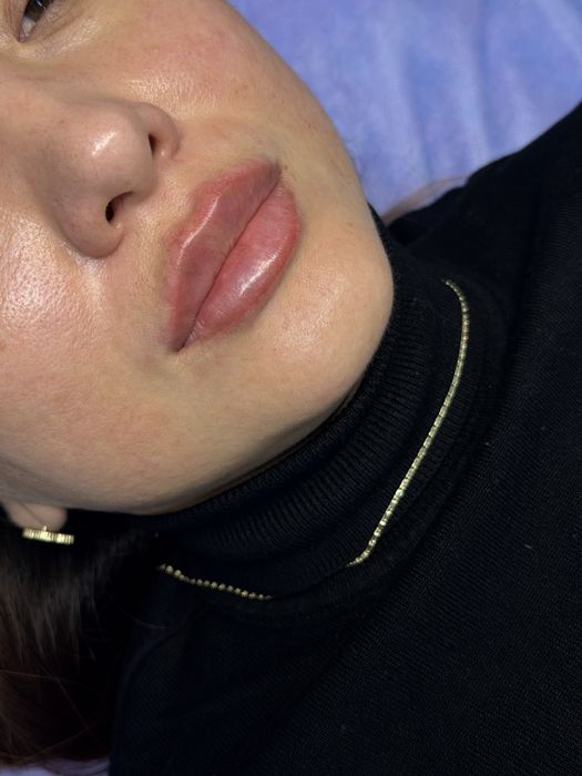 Увеличение губ Супер ЦЕНА Без перегруженности. Подберем форму под Вас.