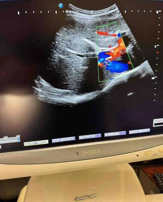 УЗИ аппарат SonoScape SSI8000