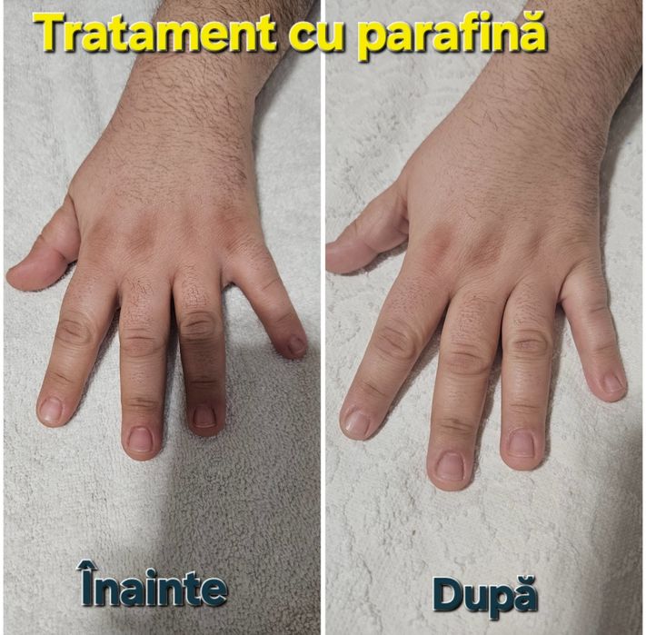 Epilare femei și bărbați, tratament cu parafina mâini și picioare