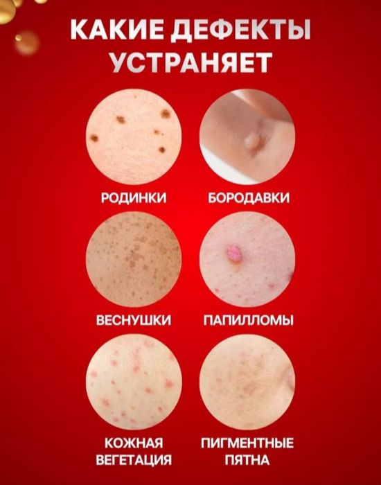 Lazer ruchka, koagulyator, papiloma, sig'il uchun kosmetik vosita