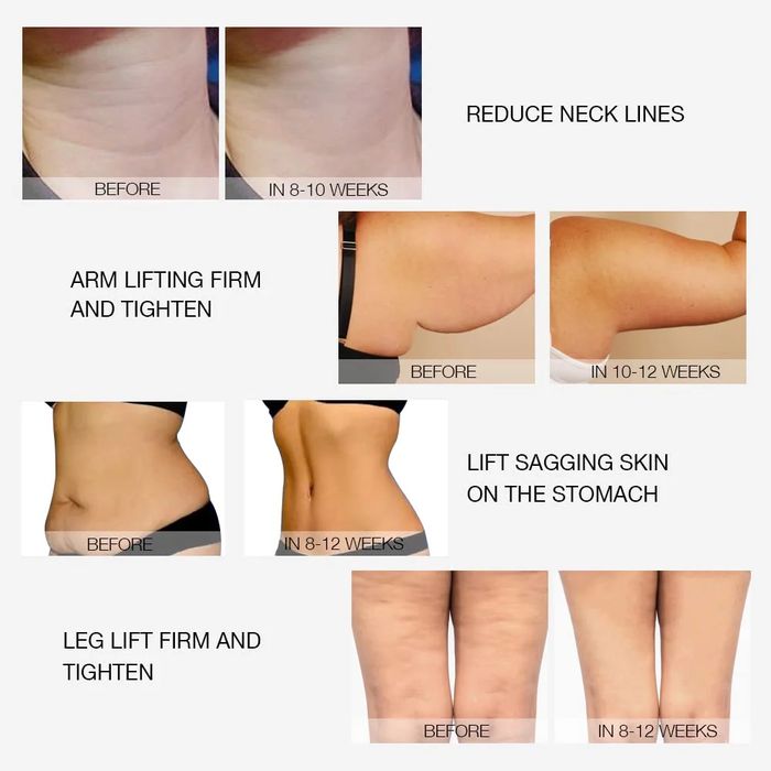 Радиочестотен лифтинг машина