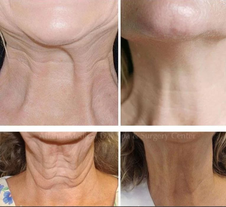 Лифтинг Нефертити — подтянутая шея и чёткий овал.