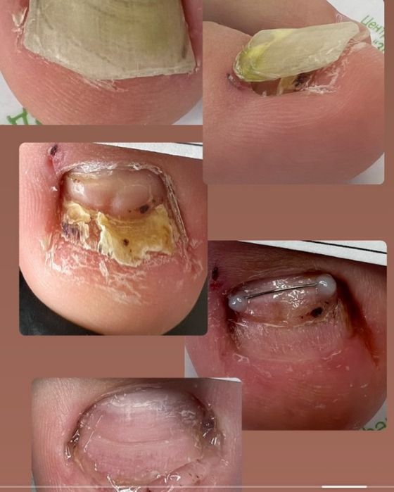 Подология лечение стоп и ногтей