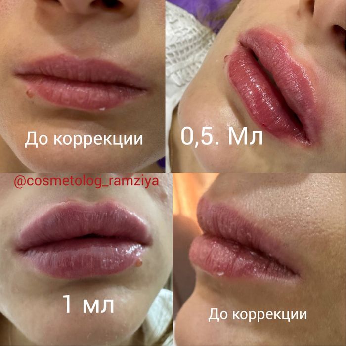Губки , филлер, ботокс . Качественно!