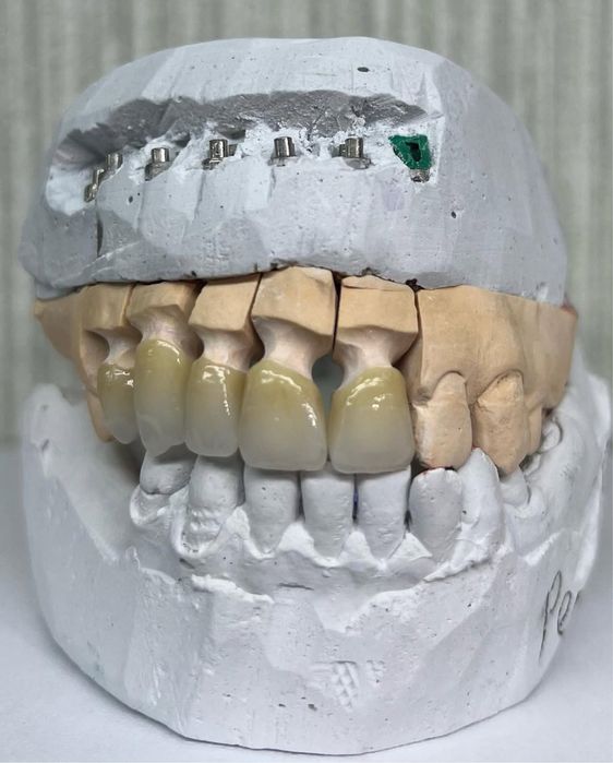 Цирконий / E-max за 2–3 дня | Luminora Dental