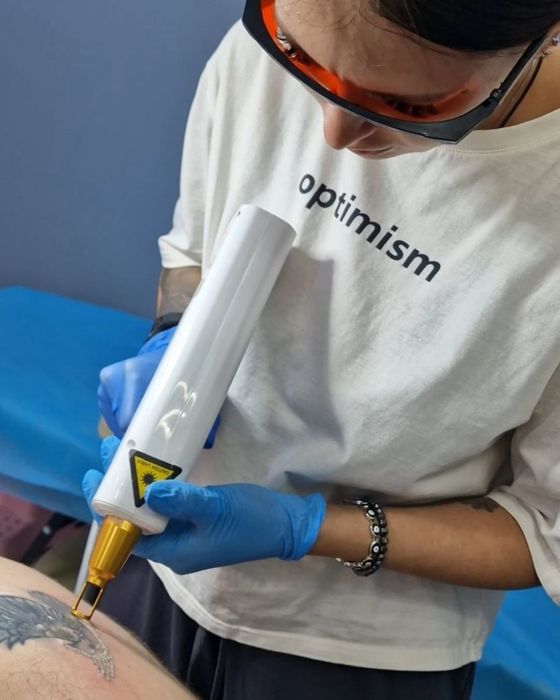 Удаление татуажа брови. 300 тысяч