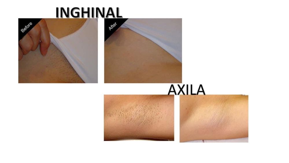 Epilare laser profesional cele mai ieftine servicii din constanta