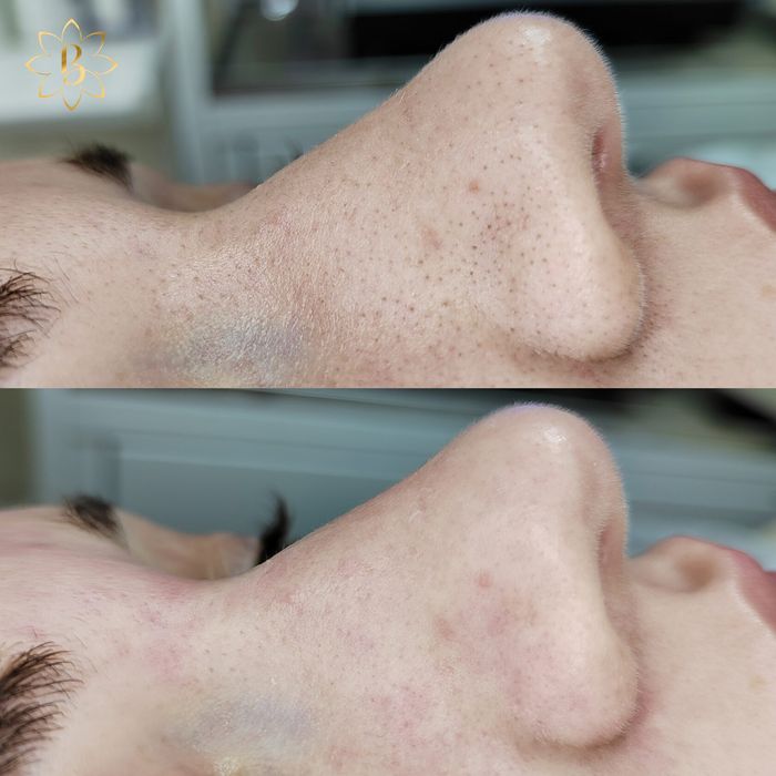 Акция по 250 тысяч Чистка лица ПилингКарбокситерапия механическая чист