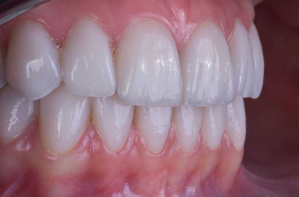 CAD/CAM Системы В Стоматологии Для Циркониевых Зубов Высокого Качества