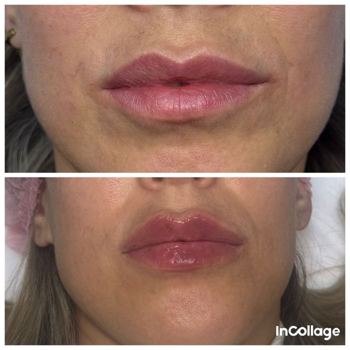 Увеличение губ