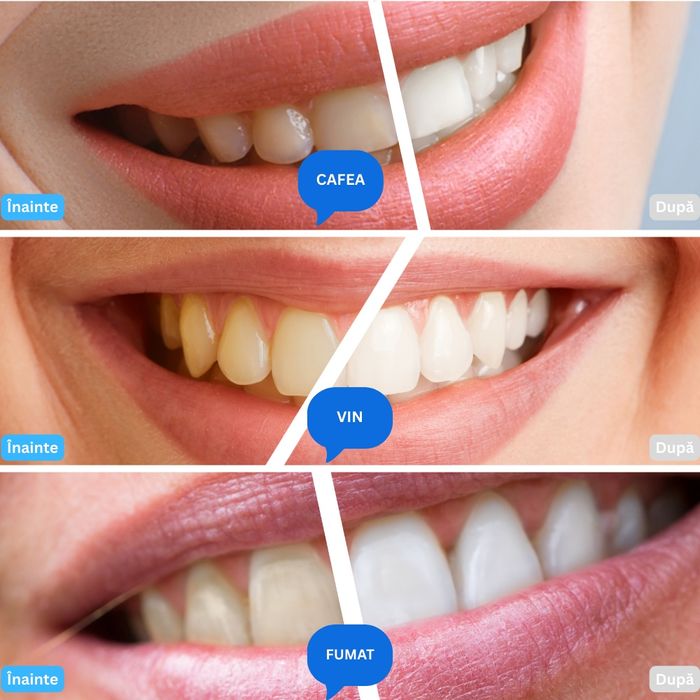 Kit de abire dinti - Set 10 seringi albire dentara