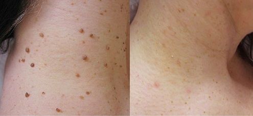 Удаление папиллома