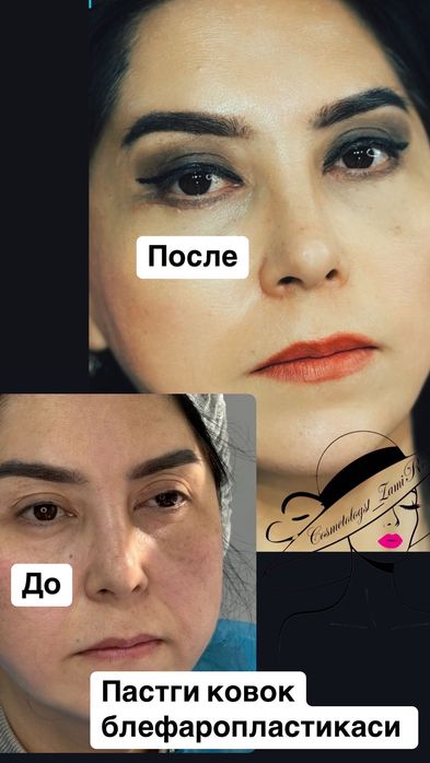 Блефаропластика Броулифтинг