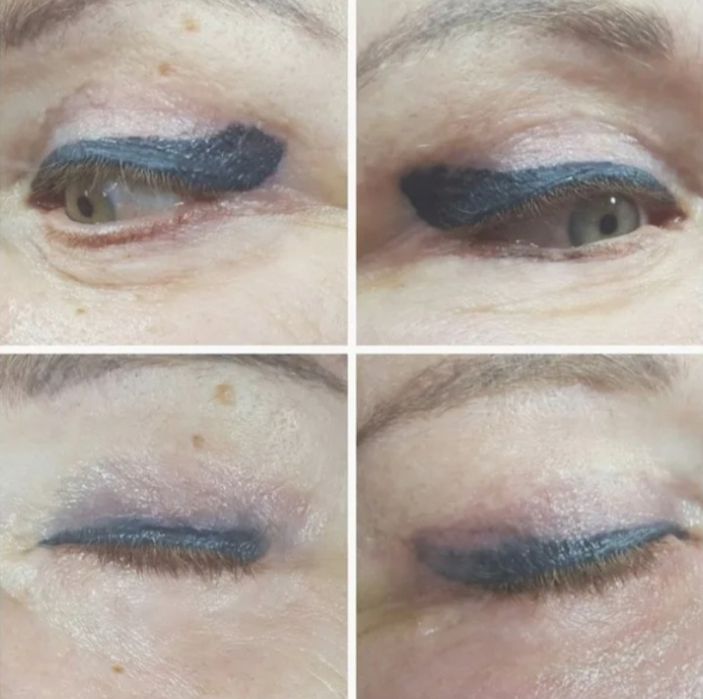 Удаление лазером тату от 5000