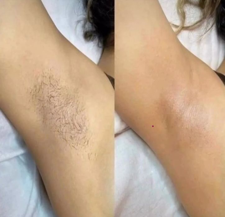 Шугаринг, восковая депиляция