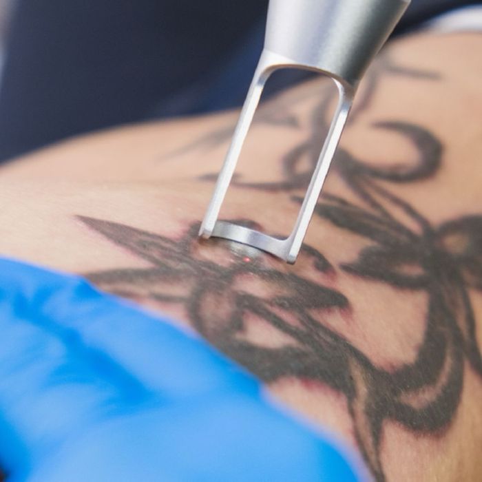 Удаление татуажа и татуировок лазером и ремувером