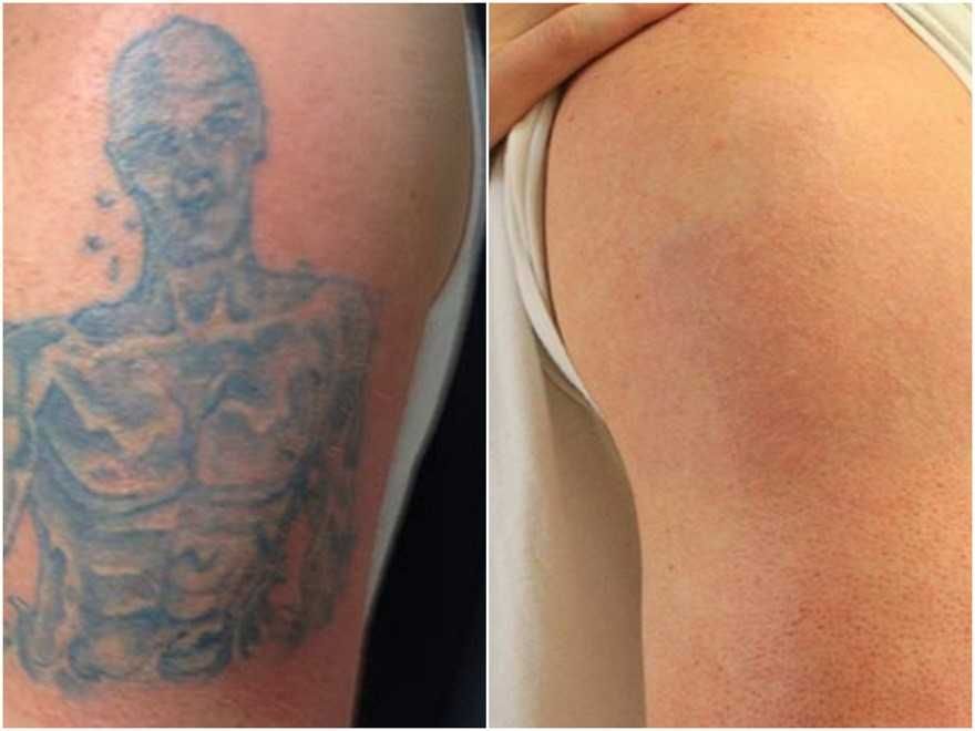 Удаление татуировок. Лазерное удаление татуировки в Ташкенте.
