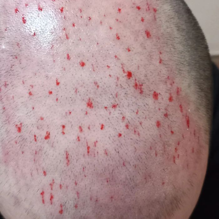 Хиджама профессионально